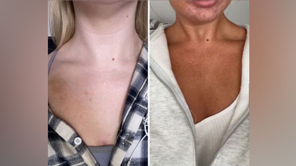 melanotan 1 vs 2 before and after Dangerous' tanning products promoted by influencers - Quomi