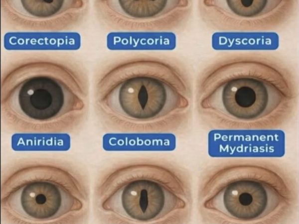 Pupil Mutations Ophthalmology and Eye Health Archives - Quomi - Healthcare meets Social