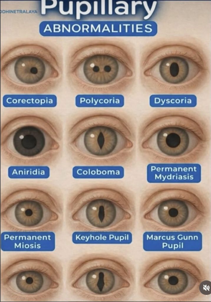 Pupillry Ruff Pupillary abnormalities, -1 - Quomi - Healthcare meets Social